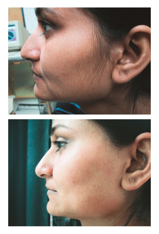 Gentle Laser Hair Removal Services Renew Skin Clinic