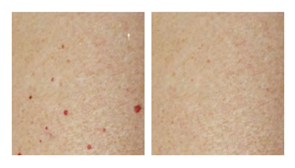 Blood Spot Removal Services Renew Skin Clinic